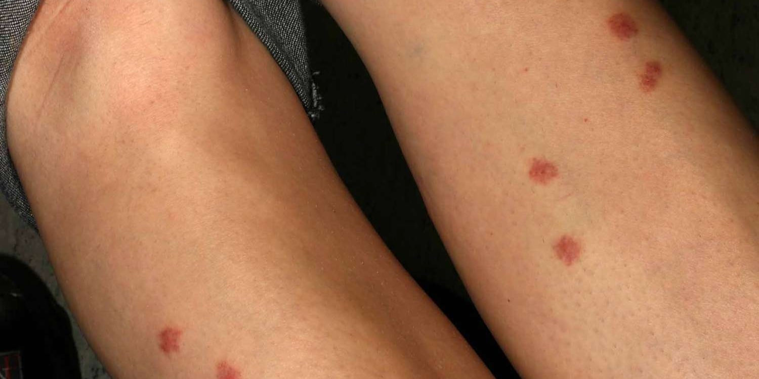 Home Remedies to Soothe Itchy Bug Bites